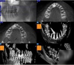 New dental ct scanner tom 9000 qr