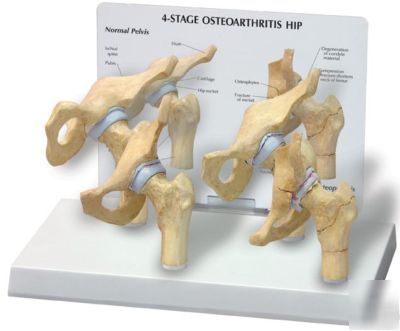 Hip joint 4 stage model arthritic #1320 frees&h