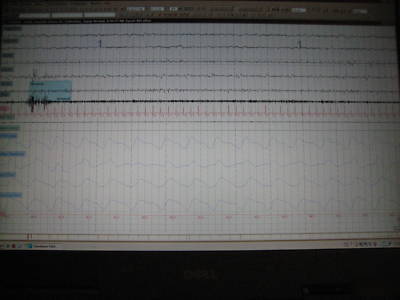 Sleep apnea diagnostic testing digital ambulatory 